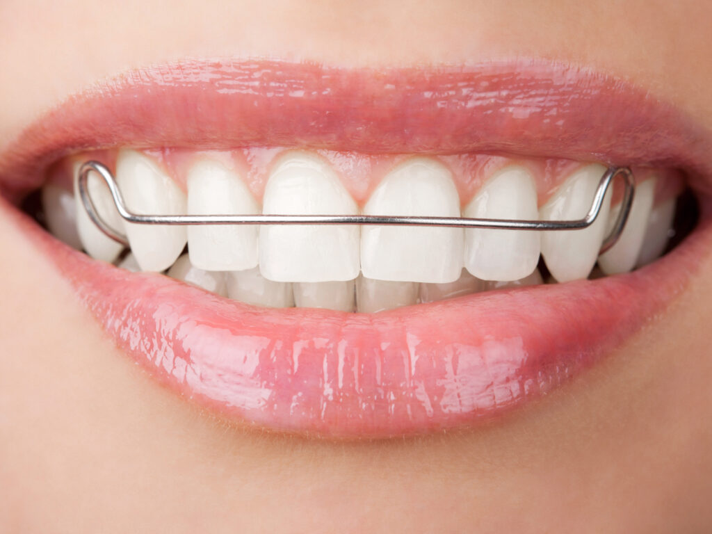 What Is A Retainer For Your Teeth at Bill Factor blog