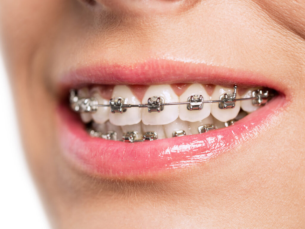 do braces change the way you talk