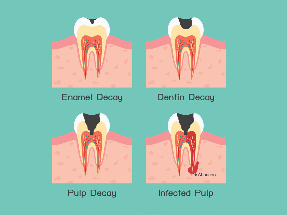 How To Prevent Tooth Decay 