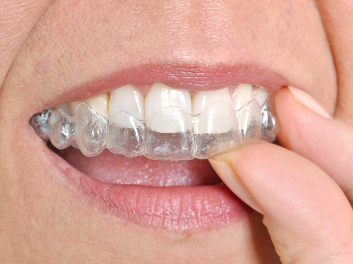 Invisalign Anchor Buttons - Centric Orthodontics