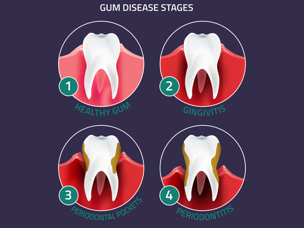 understanding-the-stages-of-gum-disease