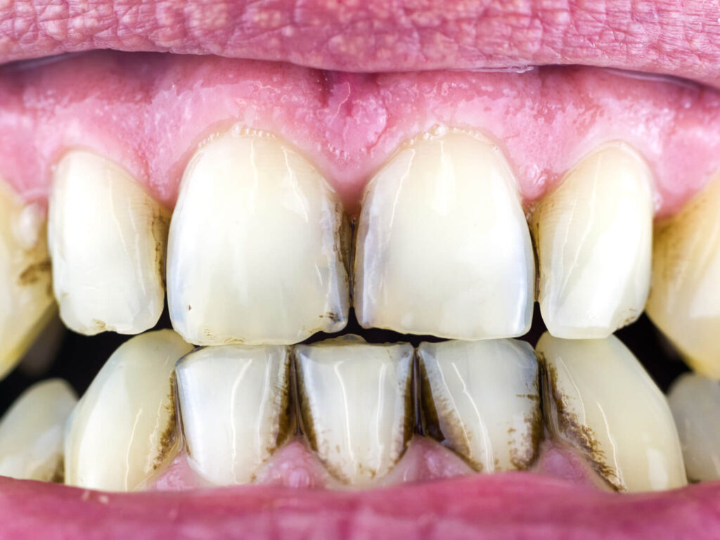 Black Tartar on Teeth: Understanding Causes, Symptoms, and Preventive ...