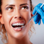 How Long Does It Take To Remove Braces?