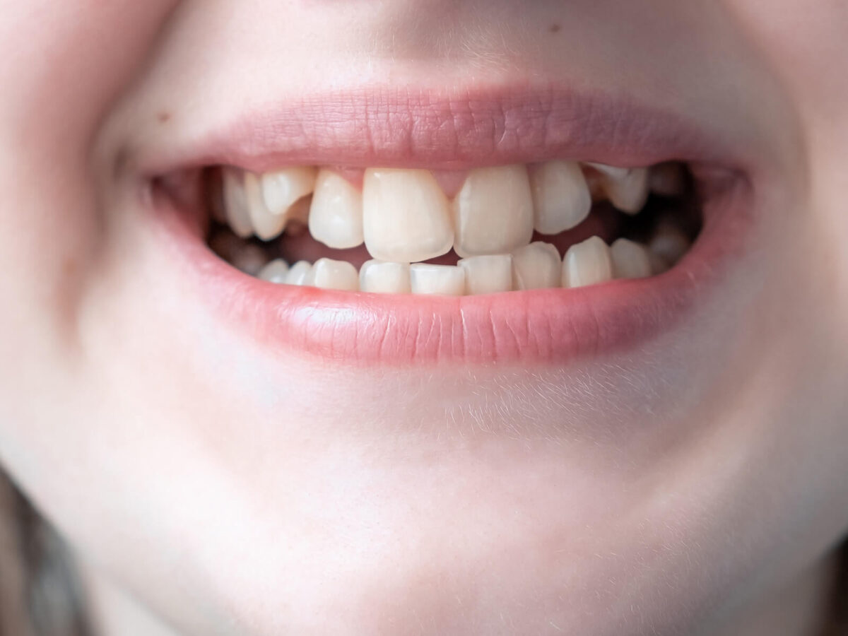 The Connection Between Dental Crowding and Crooked Teeth