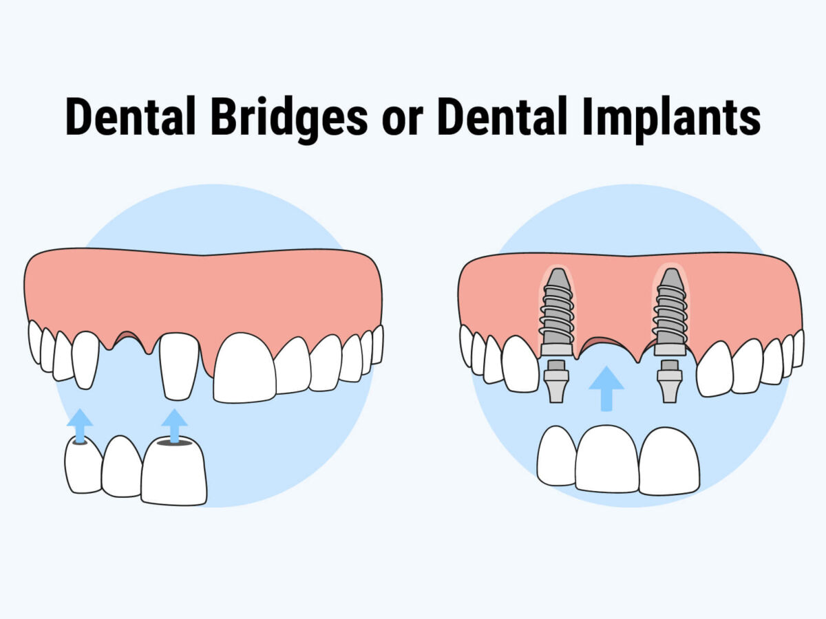 Dental Implants or Bridges: Which Is The Better Choice