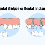 Dental Implants or Bridges: Which Is The Better Choice