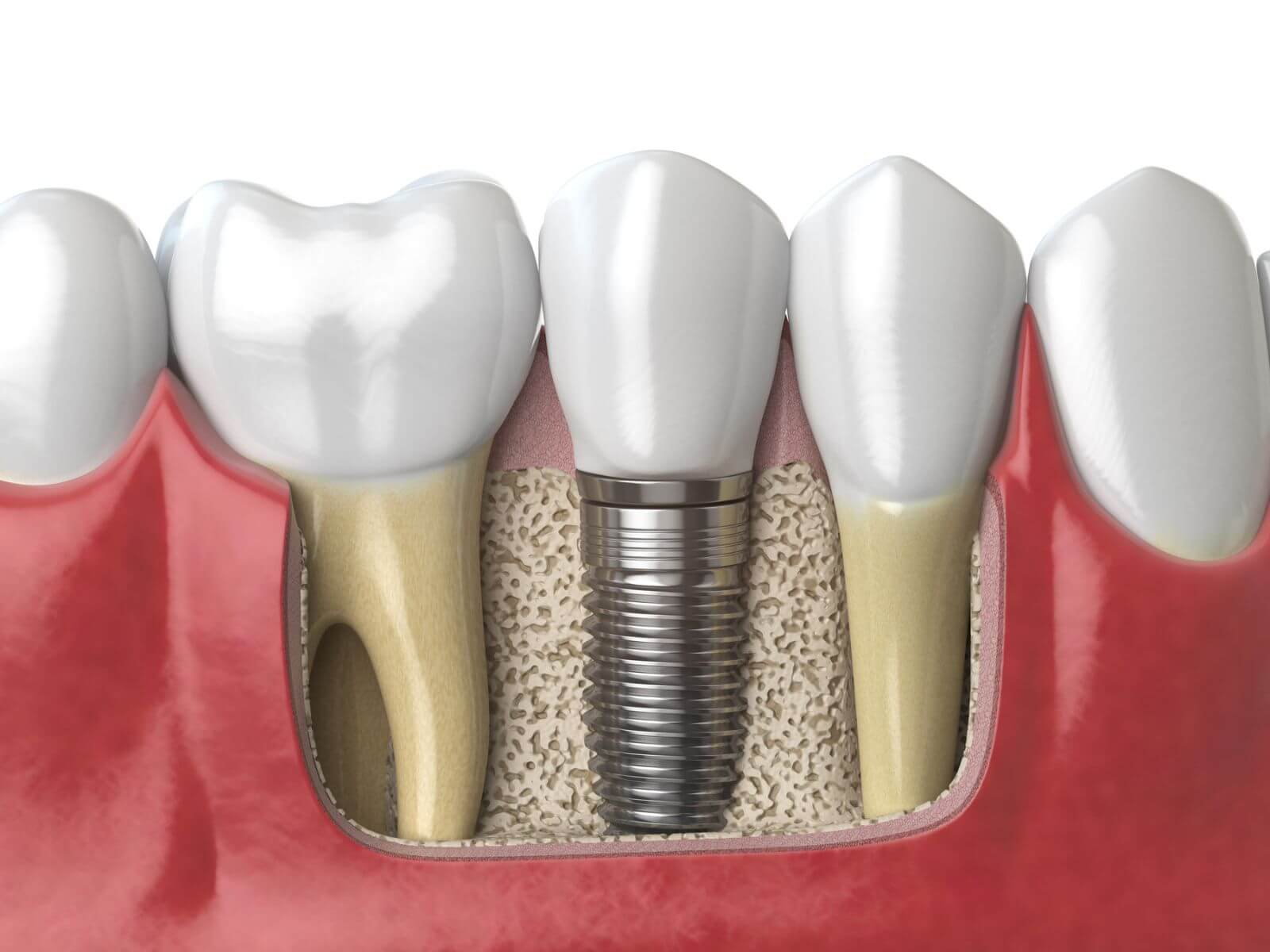 5 Benefits of Dental Implants Over Dentures