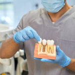 What Are The 3 Stages of Dental Implants?