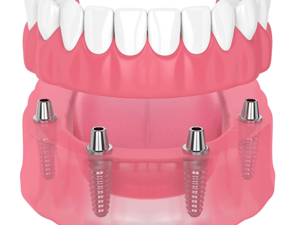 5 Benefits of Implant-Supported Dentures