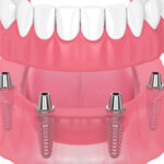 5 Benefits of Implant-Supported Dentures