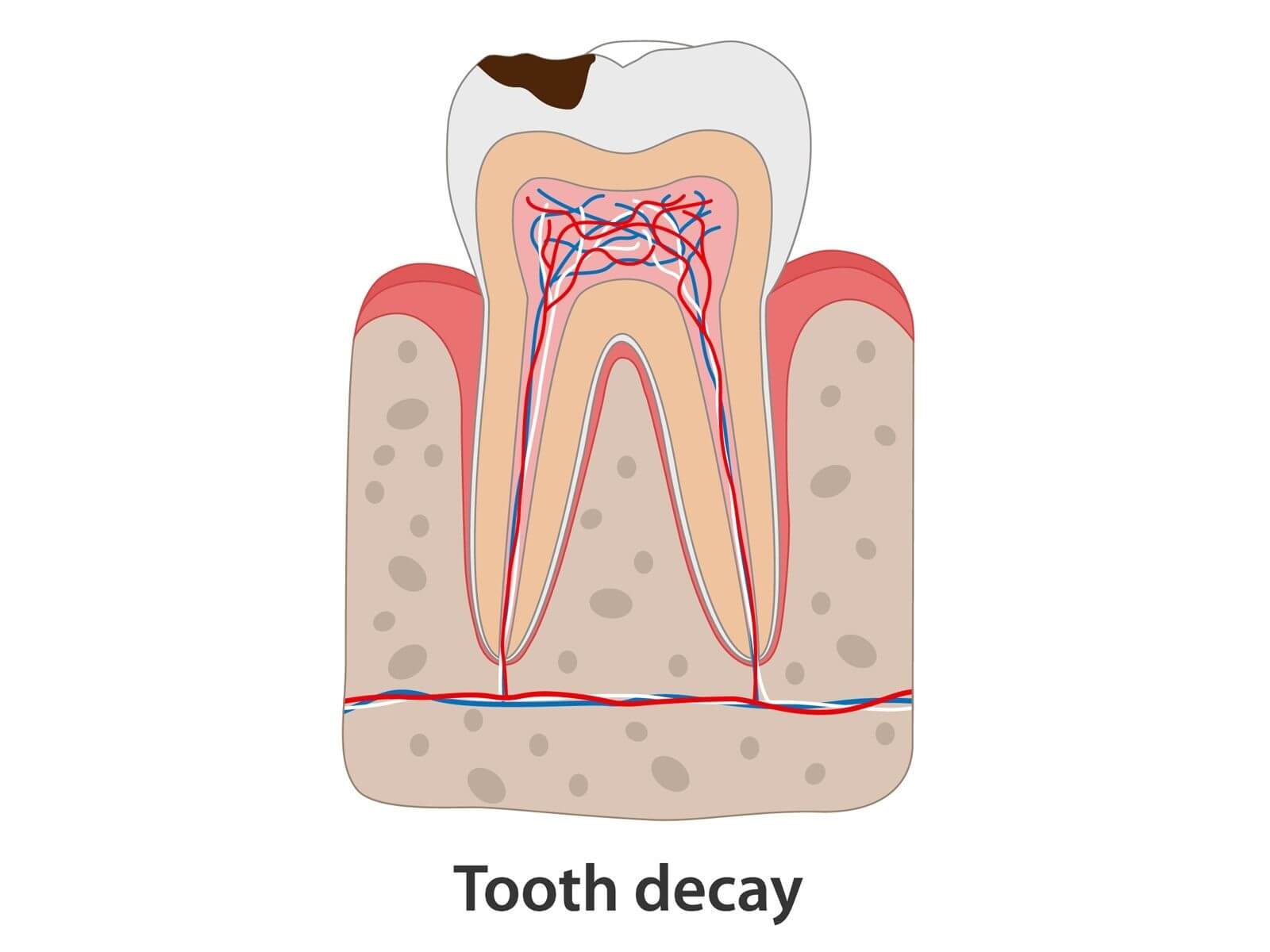 The Role of Professional Cleanings In Preventing Tooth Decay