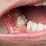 The Importance of Replacing Missing Teeth